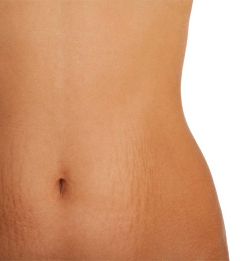 How to remove Stretch Marks